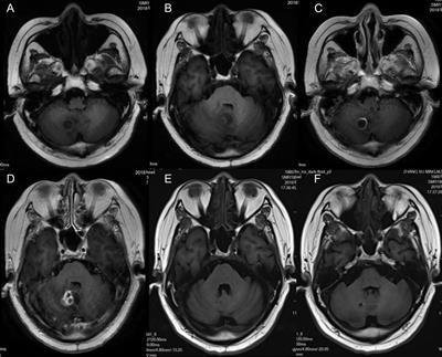 Brain Abscess Caused by Nocardia farcinica and Diagnosed by Metagenomic Next-Generation Sequencing: A Case Report